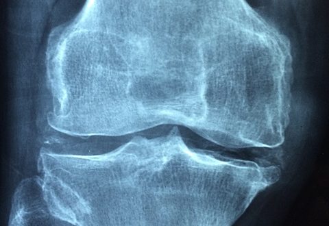 Knee Pain Arthritis