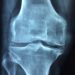 Knee Pain Arthritis