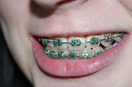 Dental Braces