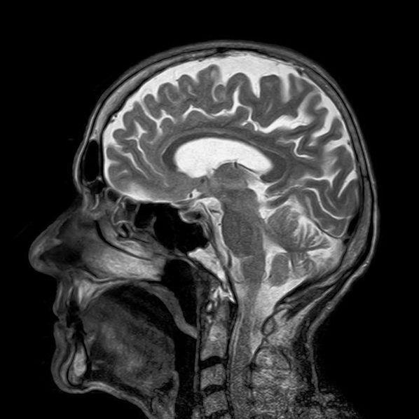 Magnetic Resonance Imaging Brain