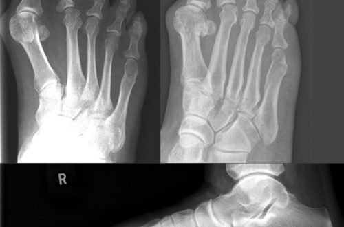 Bunion X-Ray