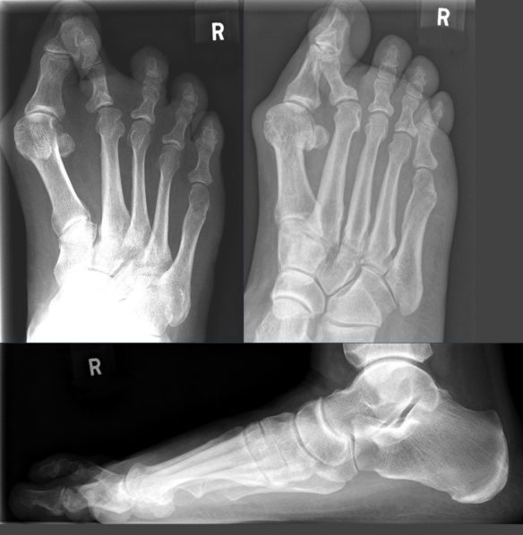 Bunion X-Ray