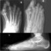 Bunion X-Ray